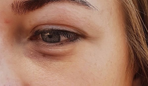 wallen, donkere kringen